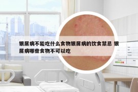銀屑病不能吃什么食物銀屑病的飲食禁忌 銀屑病哪些食物不可以吃
