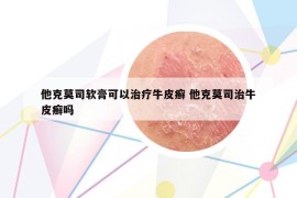 他克莫司軟膏可以治療牛皮癬 他克莫司治牛皮癬嗎