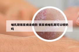 哺乳期銀屑病請(qǐng)病假 銀屑病哺乳期可以喂奶嗎