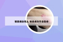 銀屑病會(huì)死么 銀屑病會(huì)不會(huì)致命