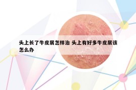頭上長了牛皮屑怎樣治 頭上有好多牛皮屑該怎么辦