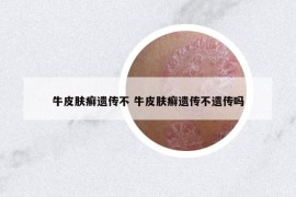 牛皮膚癬遺傳不 牛皮膚癬遺傳不遺傳嗎