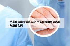 手掌硬皮銀屑病怎么辦 手掌硬皮銀屑病怎么辦用什么藥