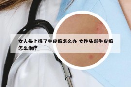 女人頭上得了牛皮癬怎么辦 女性頭部牛皮癬怎么治療