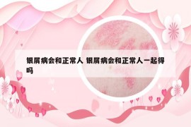 銀屑病會(huì)和正常人 銀屑病會(huì)和正常人一起得嗎