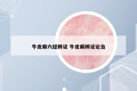 牛皮癬六經(jīng)辨證 牛皮癬辨證論治