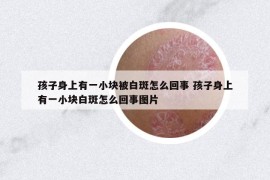 孩子身上有一小塊被白斑怎么回事 孩子身上有一小塊白斑怎么回事圖片