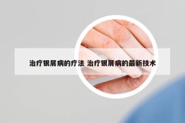 治療銀屑病的療法 治療銀屑病的最新技術(shù)