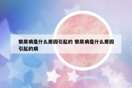 銀屑病是什么原因引起的 銀屑病是什么原因引起的病