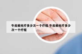 牛皮癬光療多少次一個(gè)療程 牛皮癬光療多少次一個(gè)療程