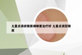 兒童點(diǎn)滴狀銀屑病哪里治療好 兒童點(diǎn)滴型銀屑