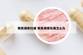 銀屑病脊柱痛 銀屑病脊柱痛怎么辦