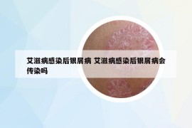 艾滋病感染后銀屑病 艾滋病感染后銀屑病會傳染嗎