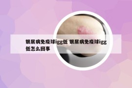 銀屑病免疫球igg低 銀屑病免疫球igg低怎么回事