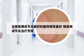 治銀屑病關(guān)節(jié)炎最好的醫(yī)院哪家最好 銀屑病關(guān)節(jié)炎治療專家