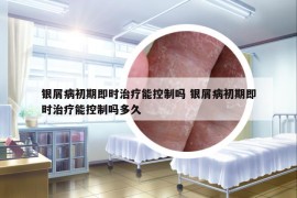 銀屑病初期即時治療能控制嗎 銀屑病初期即時治療能控制嗎多久
