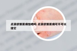 點(diǎn)滴狀銀屑病怕曬嗎 點(diǎn)滴狀銀屑病可不可以撓它