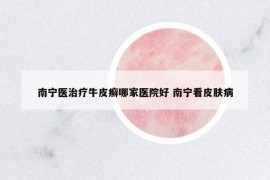 南寧醫(yī)治療牛皮癬哪家醫(yī)院好 南寧看皮膚病