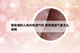 銀屑病的人體內(nèi)有濕氣嗎 銀屑病濕氣重怎么調(diào)理