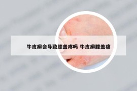 牛皮癬會導致膝蓋疼嗎 牛皮癬膝蓋痛