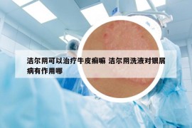 潔爾陰可以治療牛皮癬嘛 潔爾陰洗液對銀屑病有作用哪
