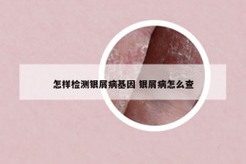怎樣檢測(cè)銀屑病基因 銀屑病怎么查