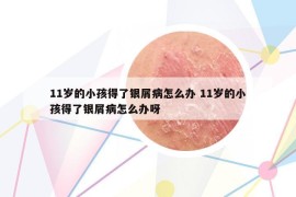 11歲的小孩得了銀屑病怎么辦 11歲的小孩得了銀屑病怎么辦呀