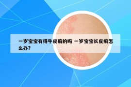 一歲寶寶有得牛皮癬的嗎 一歲寶寶長(zhǎng)皮癬怎么辦?