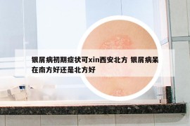 銀屑病初期癥狀可xin西安北方 銀屑病呆在南方好還是北方好