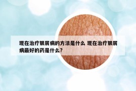 現(xiàn)在治療銀屑病的方法是什么 現(xiàn)在治療銀屑病最好的藥是什么?