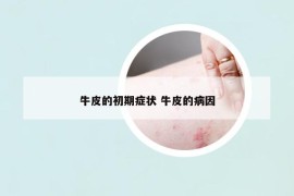 牛皮的初期癥狀 牛皮的病因