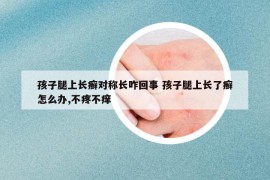 孩子腿上長癬對稱長咋回事 孩子腿上長了癬怎么辦,不疼不癢