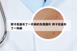 脖子后面長(zhǎng)了一片癬的東西圖片 脖子后面長(zhǎng)了一塊癬