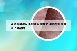 點滴銀屑病從頭部開始沒有了 點滴型銀屑病頭上會起嗎