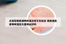 點(diǎn)滴型銀屑病喝啤酒沒(méi)有不良反應(yīng) 銀屑病患者喝啤酒后大量喝水好嗎