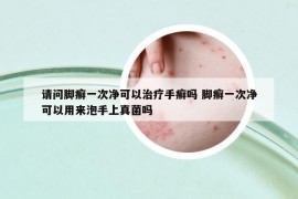 請問腳癬一次凈可以治療手癬嗎 腳癬一次凈可以用來泡手上真菌嗎
