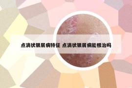 點滴狀銀屑病特征 點滴狀銀屑病能根治嗎