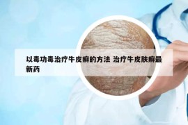 以毒功毒治療牛皮癬的方法 治療牛皮膚癬最新藥