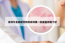 鄭州牛皮癬研究所和鄭州第一附屬醫(yī)院哪個好