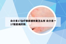 白介素17治療銀屑病效果怎么樣 白介素一17銀屑病藥物