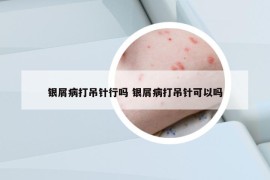 銀屑病打吊針行嗎 銀屑病打吊針可以嗎