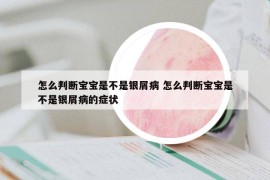 怎么判斷寶寶是不是銀屑病 怎么判斷寶寶是不是銀屑病的癥狀