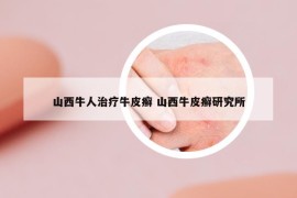 山西牛人治療牛皮癬 山西牛皮癬研究所