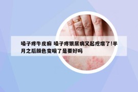 嗓子疼牛皮癬 嗓子疼銀屑病又起疙瘩了!半月之后顏色變暗了是要好嗎