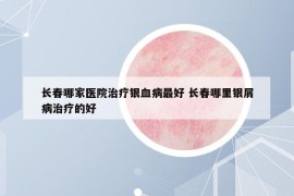 長春哪家醫(yī)院治療銀血病最好 長春哪里銀屑病治療的好