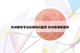 杭州哪有專治白癜風(fēng)的醫(yī)院 杭州有哪些醫(yī)院