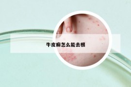 牛皮癬怎么能去根
