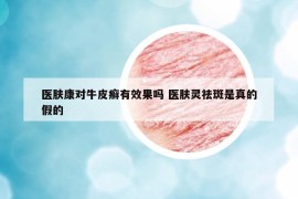 醫(yī)膚康對牛皮癬有效果嗎 醫(yī)膚靈祛斑是真的假的