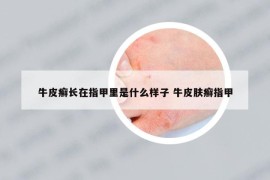 牛皮癬長在指甲里是什么樣子 牛皮膚癬指甲