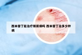 西米替丁能治療銀屑病嗎 西米替丁治多少種病
